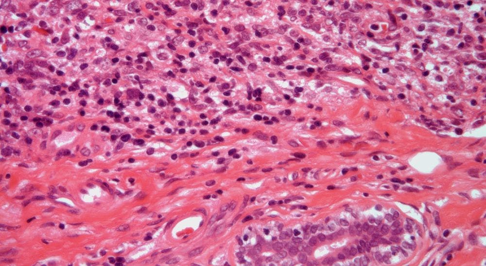 Breast Mass Discovered in 52-Year-Old Patient
