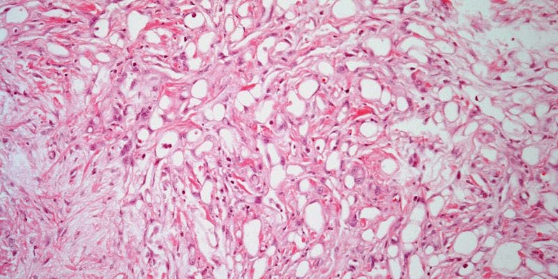 Patient Presents With Tumor in the Epididymis
