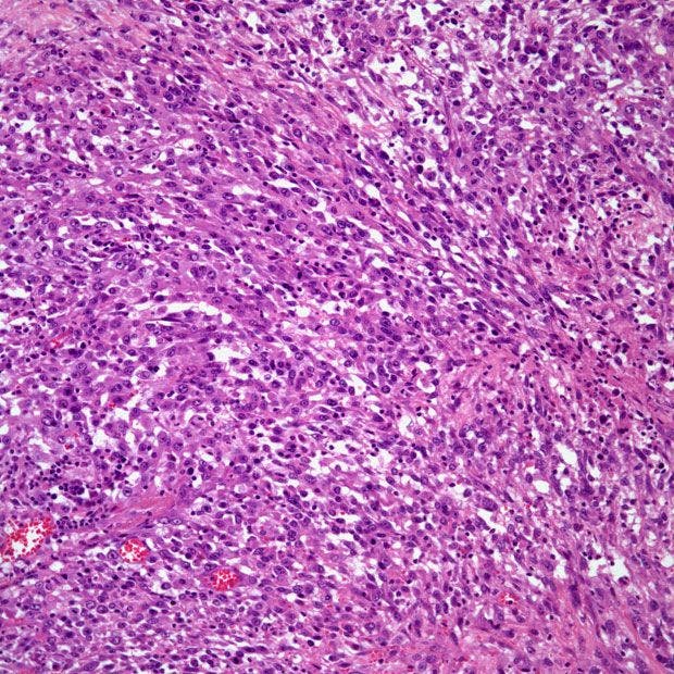 Intrapulmonary Mass Found in 58-Year-Old Patient
