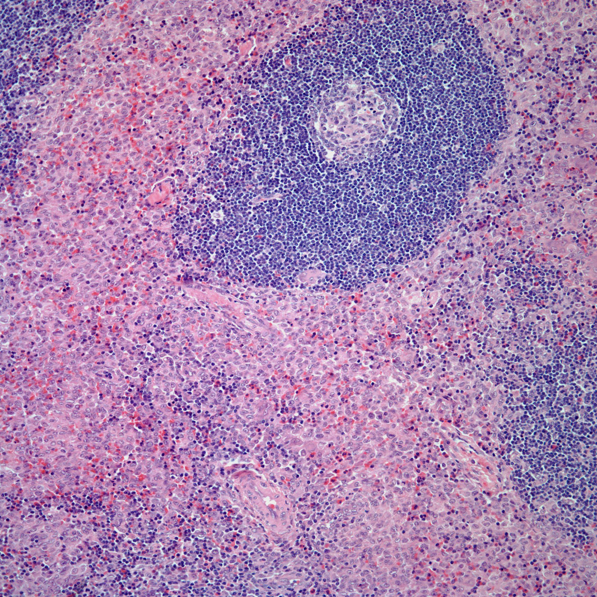23-Year-Old Woman Presents With Cervical Lymphadenopathy