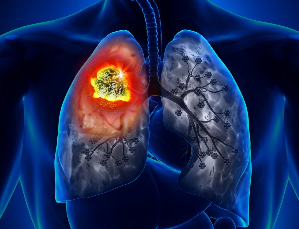 Results from the phase 2 KRYSTAL-1 trial led to the approval of adagrasib for patients with KRAS G12C–mutated non–small cell lung cancer by the European Commission. 