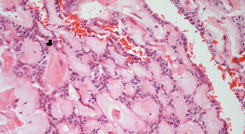 Soft-Tissue Mass Discovered in 14-Year-Old Patient