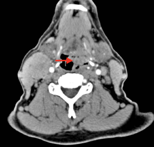 Which Larynx-Preservation Strategy Would Be Best for a Patient With Resectable, Locally Advanced, Hypopharynx Squamous Cell Carcinoma?