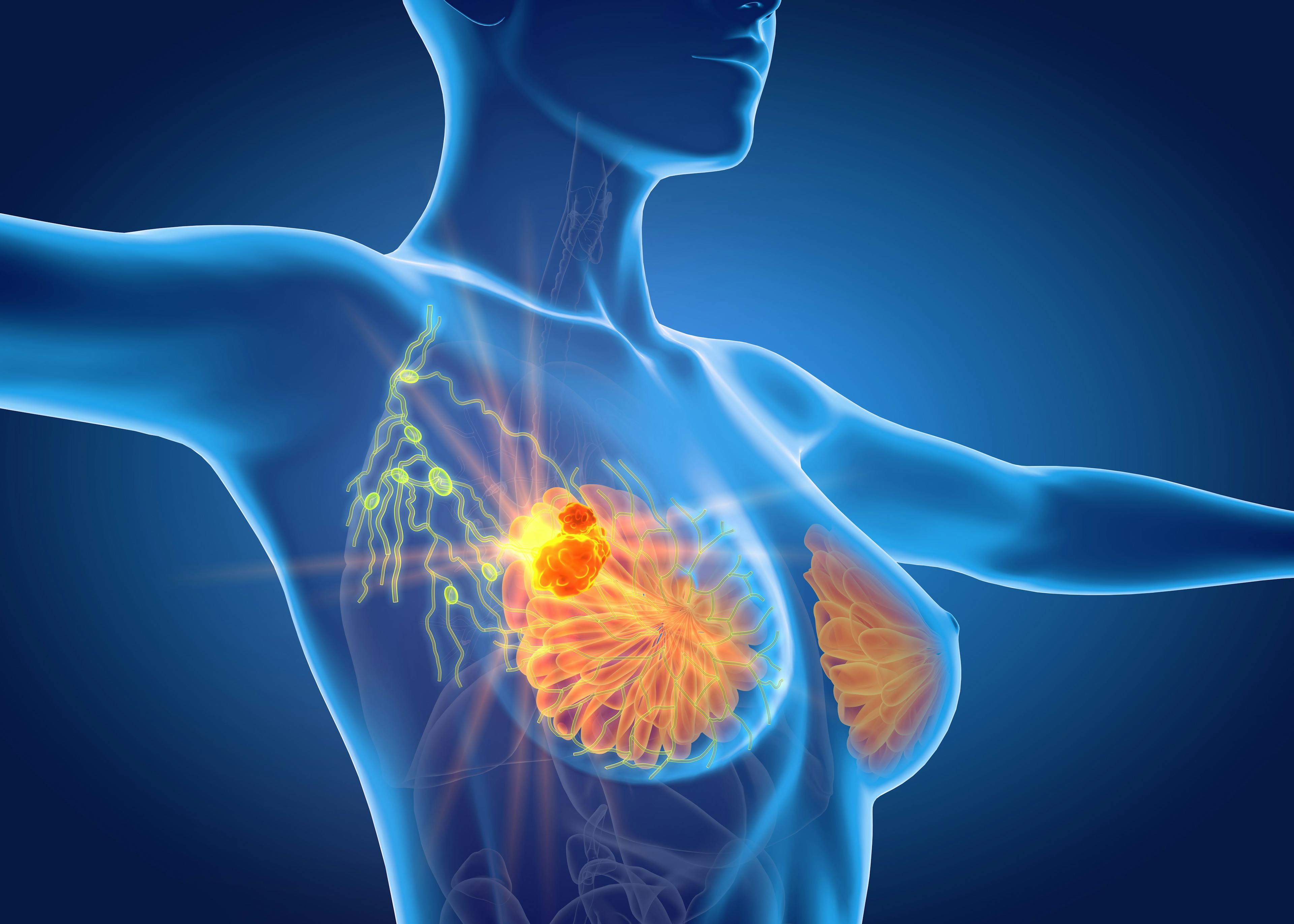 Clipping of Lymph Nodes May Aid Axillary Surgery in Breast Cancer