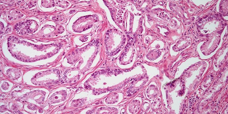 Prostate Biopsy From 56-Year-Old Patient