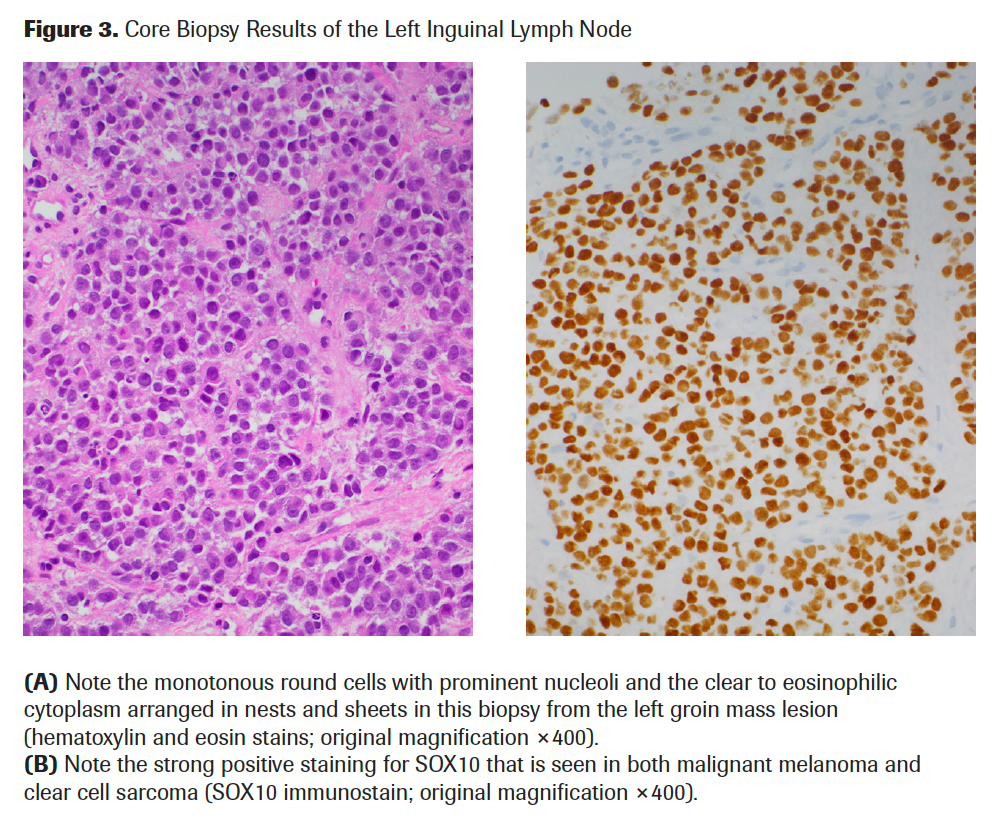 Figure 3. Core Biopsy Results of the Left Inguinal Lymph Node