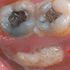 Oral Cancer Patient Presents With Pain in Mouth