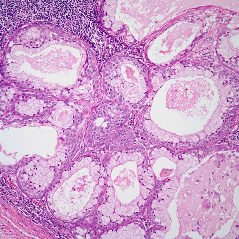 Patient Presents With Tongue Lesion 