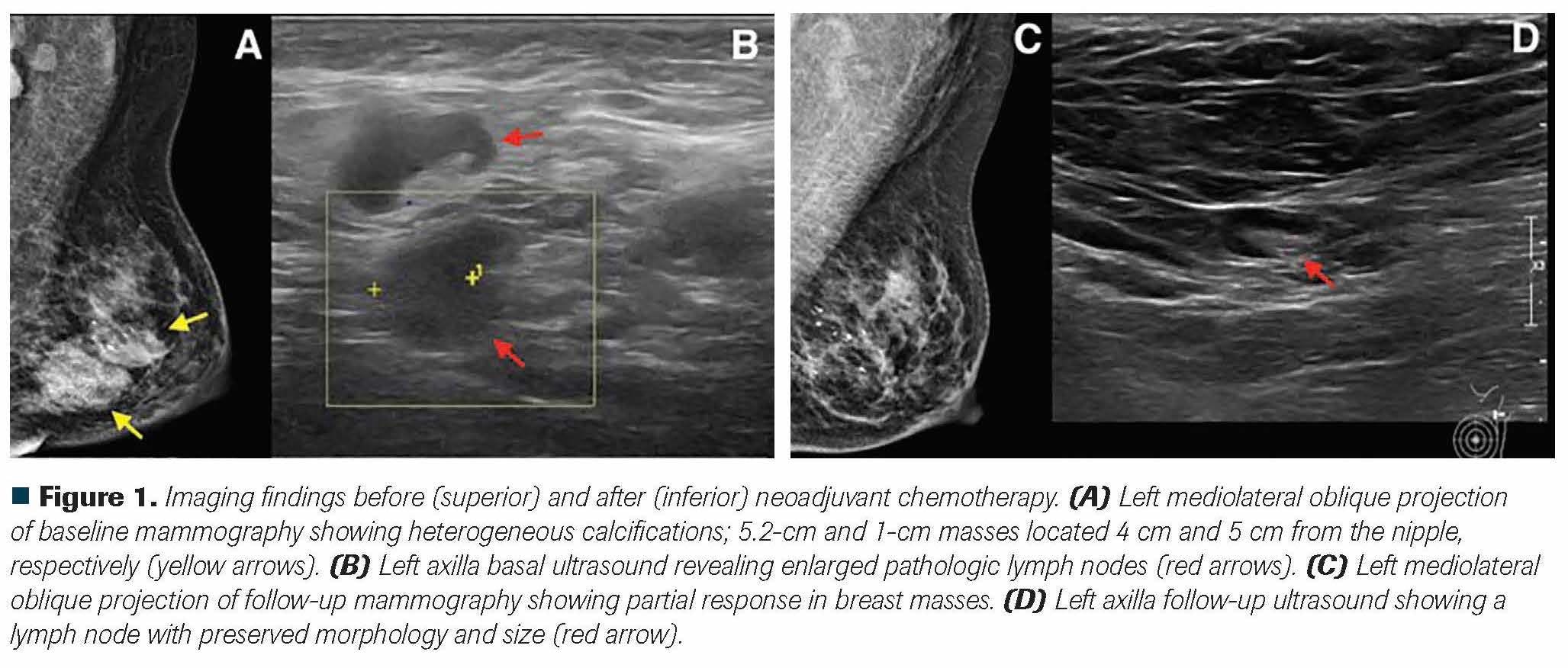 Figure 1. Imaging findings before (superior) and after (inferior) neoadjuvant chemotherapy. (A) Left mediolateral oblique projection of baseline mammography showing heterogeneous calcifications; 5.2-cm and 1-cm masses located 4 cm and 5 cm from the nipple, respectively (yellow arrows). (B) Left axilla basal ultrasound revealing enlarged pathologic lymph nodes (red arrows). (C) Left mediolateral oblique projection of follow-up mammography showing partial response in breast masses. (D) Left axilla follow-up ultrasound showing a lymph node with preserved morphology and size (red arrow).