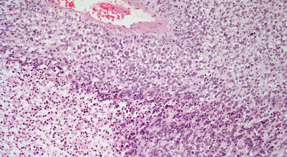 Uterine Tumor Found in 43-Year-Old Patient
