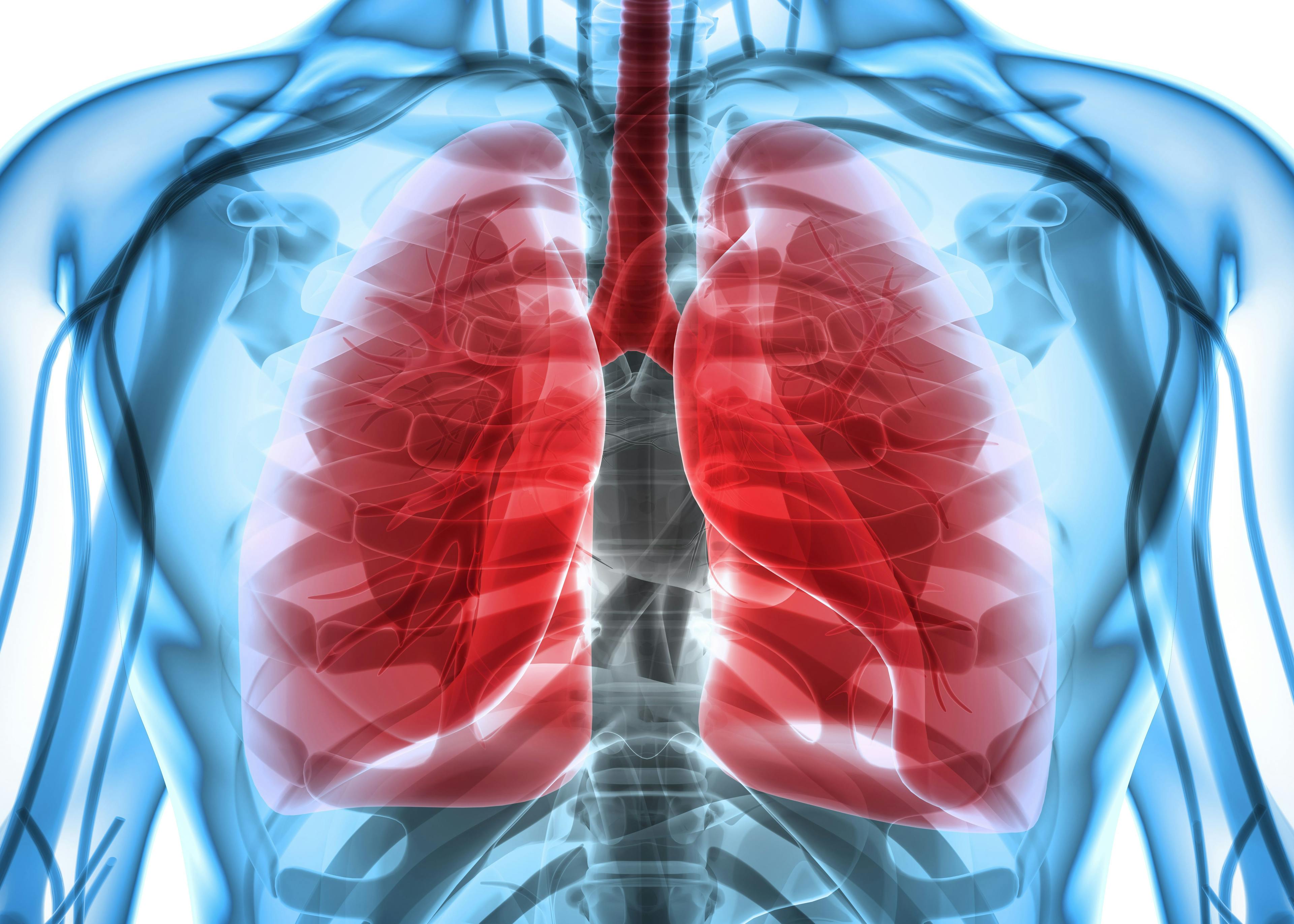 Amivantimab produces superior progression-free survival in EGFR exon 20 insertion–positive non–small-cell lung cancer.