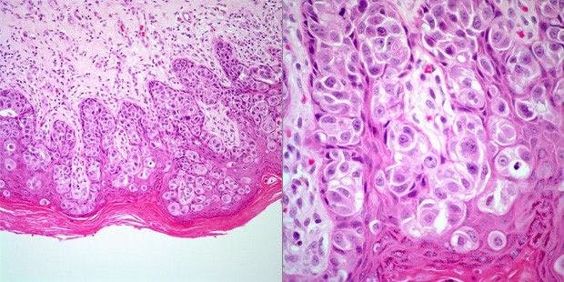 A 52-Year-Old Man Presents With an Erythematous Lesion