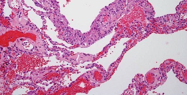 "In summary, the combination of olaparib and temozolomide provided encouraging activity in pretreated [uterine leiomyosarcoma], an aggressive sarcoma subtype without an effective targeted therapy," according to the authors of a phase 2 study published in Journal of Clinical Oncology.