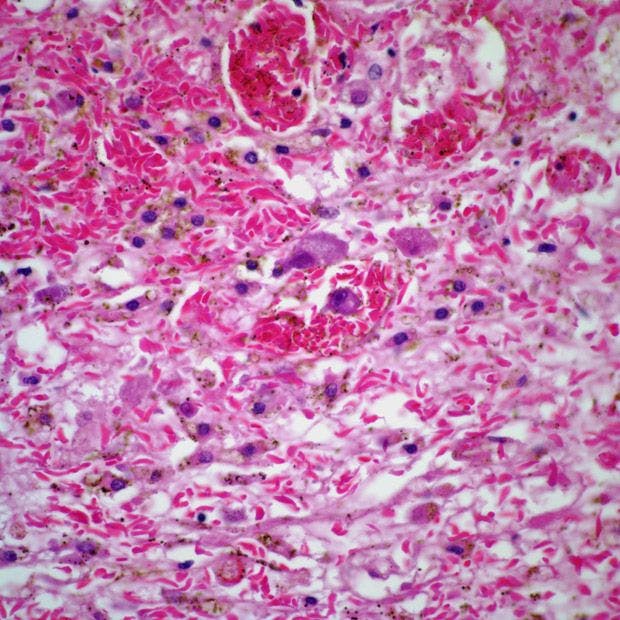 Adrenal Gland Lesion in 30-Year-Old Patient