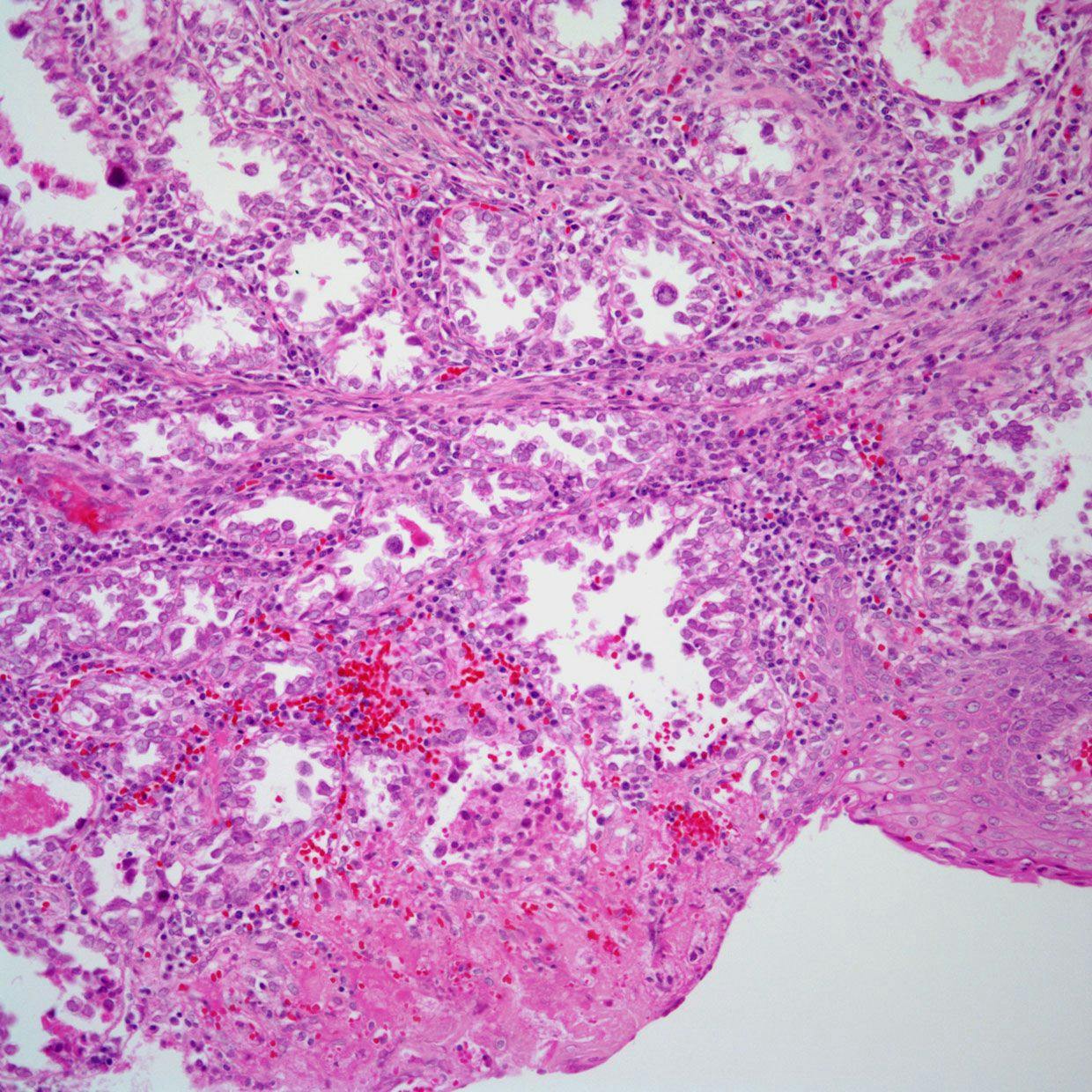 Vaginal Mass in 54-Year-Old Patient