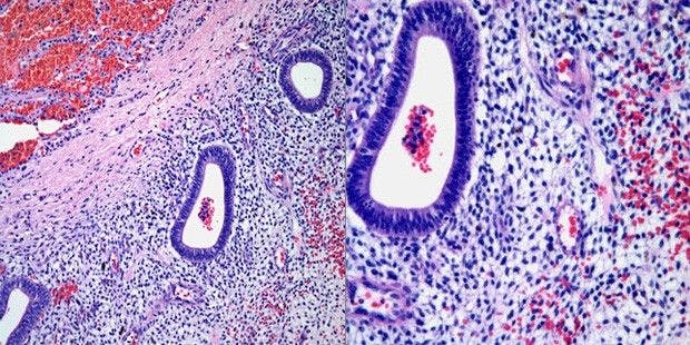 Pleural Nodules Discovered in 34-Year-Old Woman