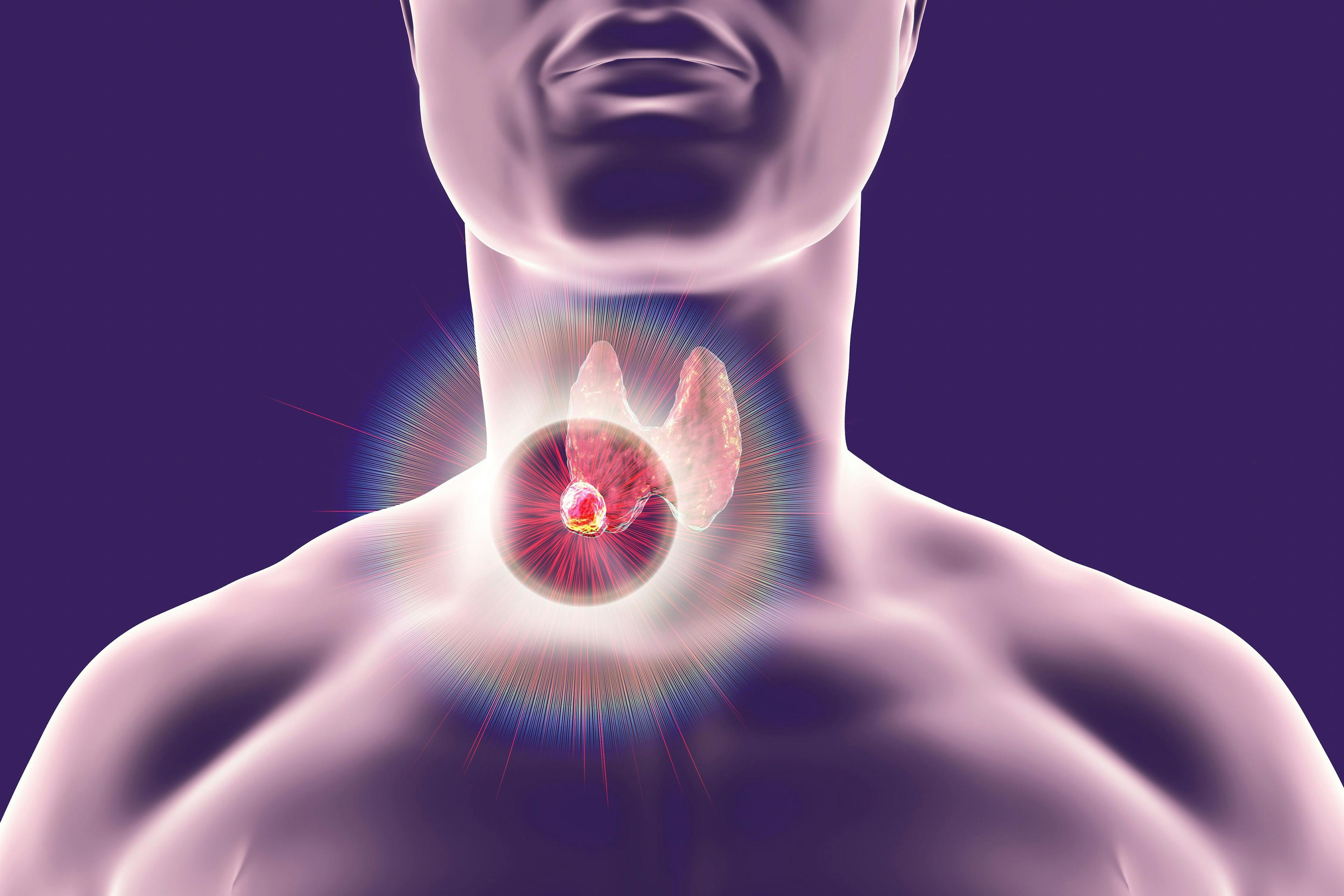 CAR T-Cell Therapy AIC100 for Certain Types of Thyroid Cancer Earns Fast Track Designation