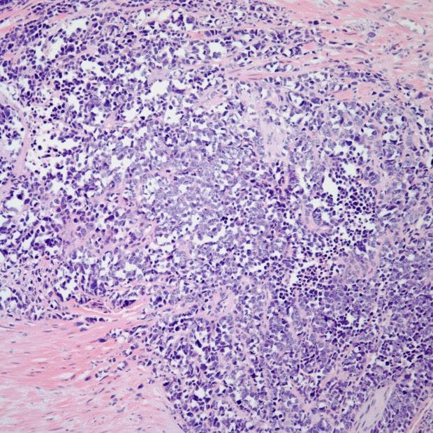 Prostate Biopsy From 67-Year-Old Patient