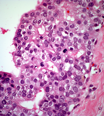 Pathologists Often Disagree on Breast Biopsy Findings