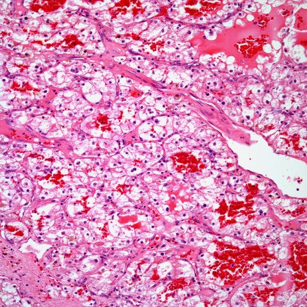 Right Kidney Mass Found in 52-Year-Old Patient