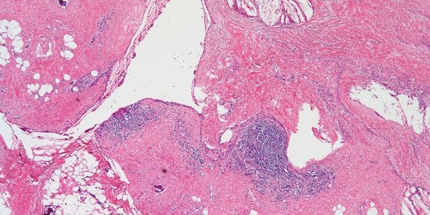 Large Mediastinal Mass Found in 35-Year-Old Patient