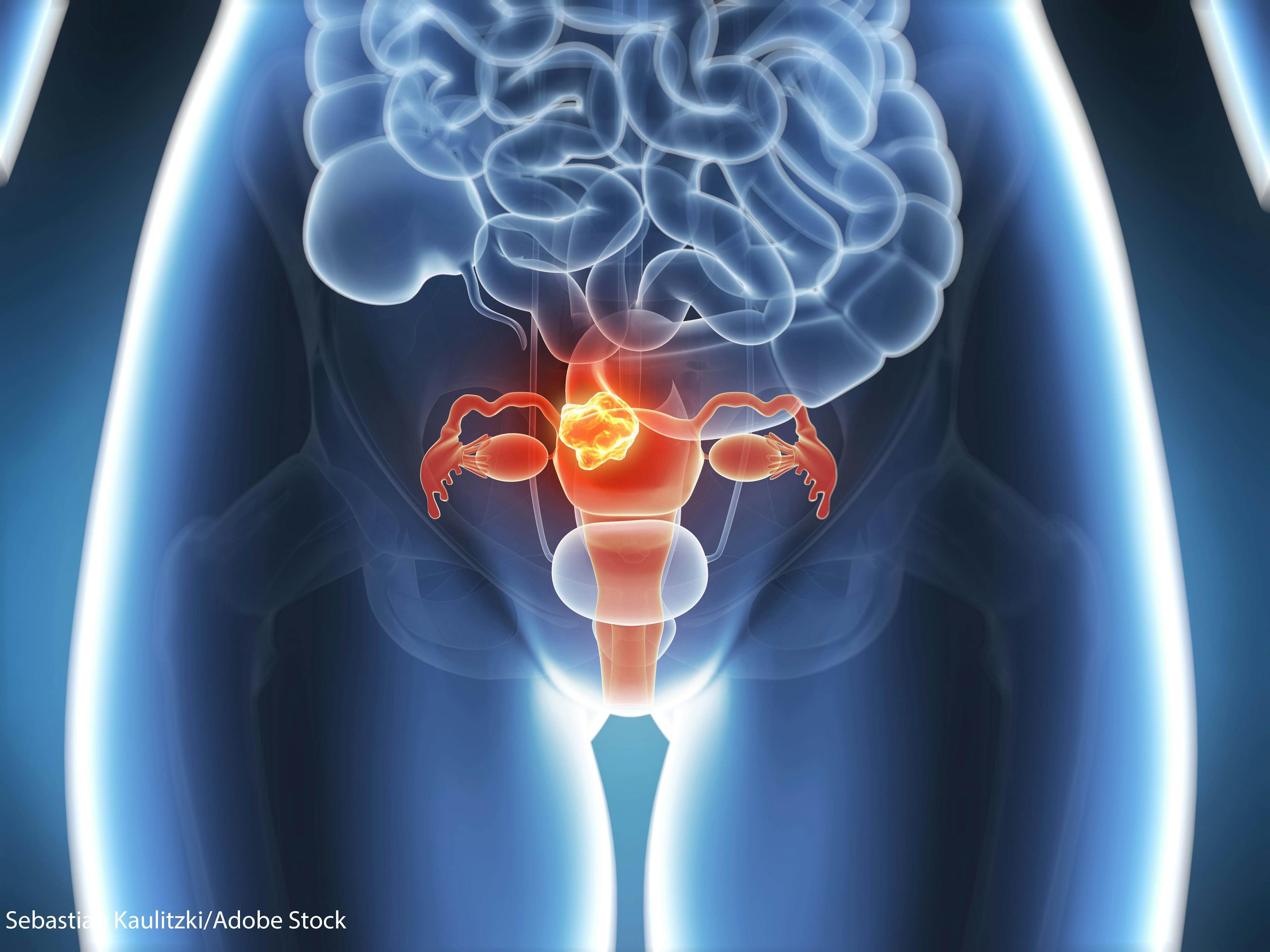 Adavosertib Induces Tumor Shrinkage in 30% of Patients with Uterine Serous Carcinoma