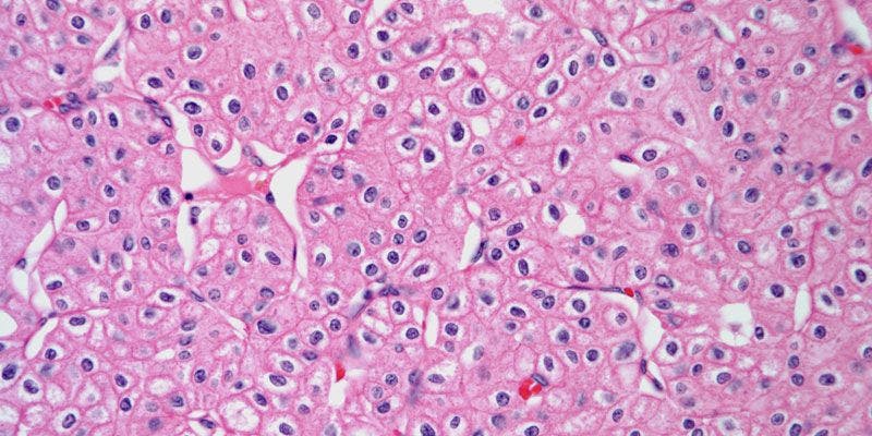Kidney Mass Discovered in 62-Year-Old Patient