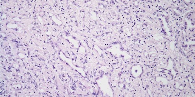 Fallopian Tube Tumor Found in 43-Year-Old Patient