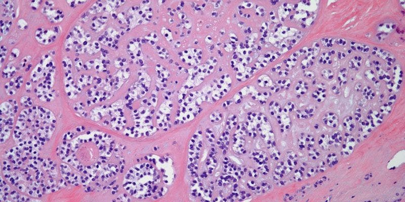 Mass in Parotid Gland of 39-Year-Old Patient