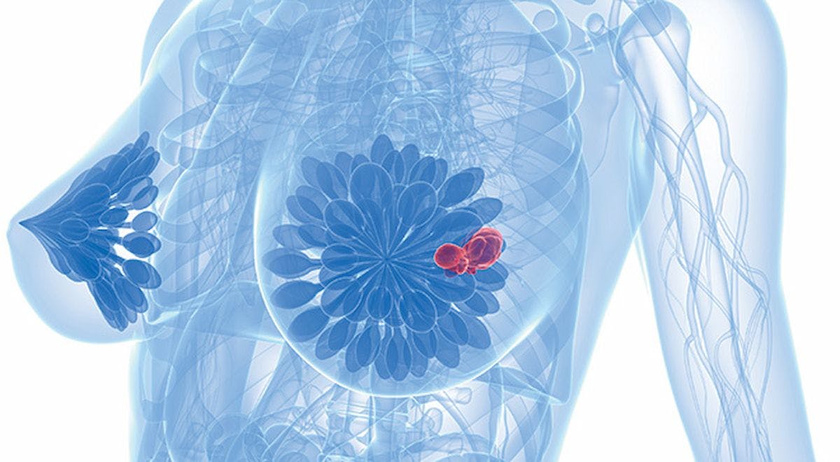 Patient data from 4 clinical trials suggests HER2-low–positive tumors can be seen as a new breast cancer subgroup, specifically distinct from HER2-zero tumors.