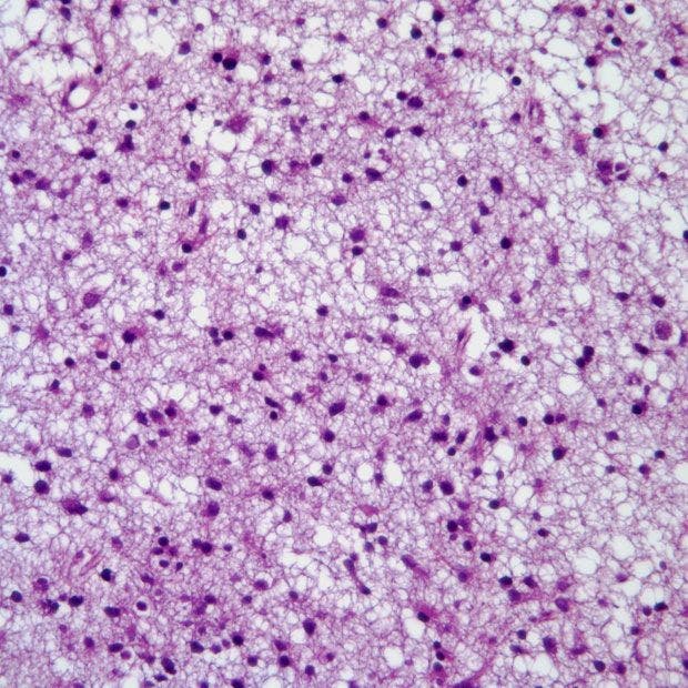 "The results from the Phase 3 INDIGO trial offer patients with IDH mutant low-grade glioma potential hope for a new treatment option for the first time in more than 20 years,” according to the manufacturers of vorasidenib.