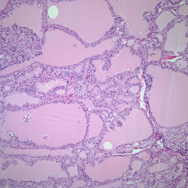 Thyroid Mass in 37-Year-Old Patient