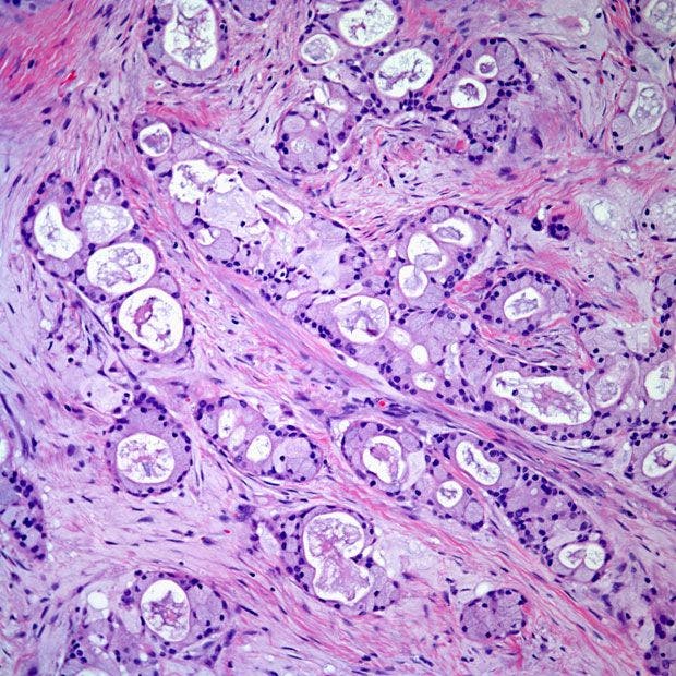 Bronchial Tumor Discovered in 14-Year-Old Girl