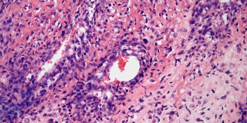 Tumor Found in Humerus of 18-Year-Old Patient
