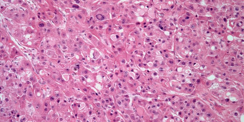 Liver Mass Discovered in 36-Year-Old Patient