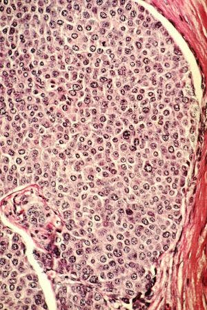 Can Metastasis of Triple-Negative Breast Cancer Be Thwarted?