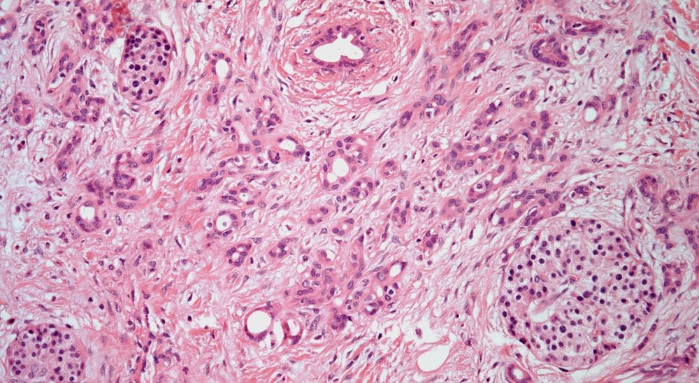 Pancreatic Mass in 54-Year-Old Patient