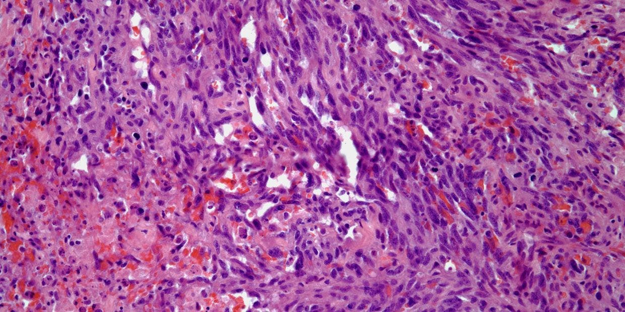 Breast Mass Found in 48-Year-Old Patient
