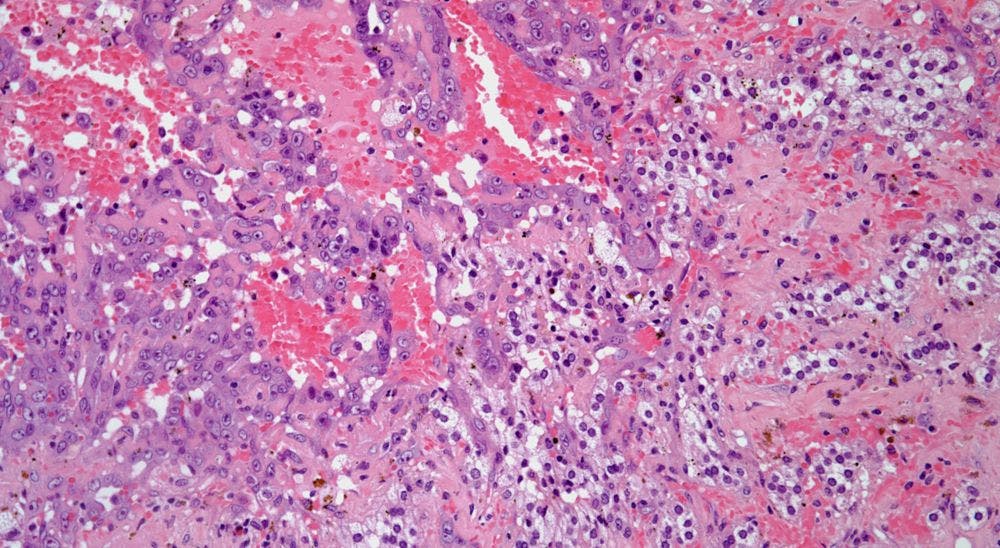 Mass Found in Adrenal Gland of 52-Year-Old Patient