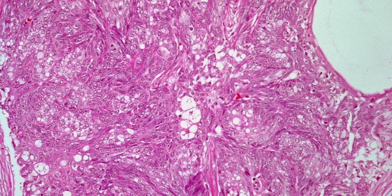 Chest Lesion Discovered in 49-Year-Old Patient