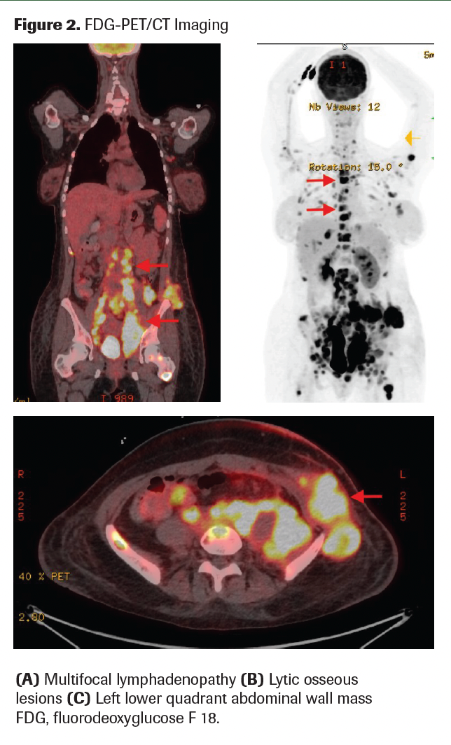 Figure 2. FDG-PET/CT Imaging