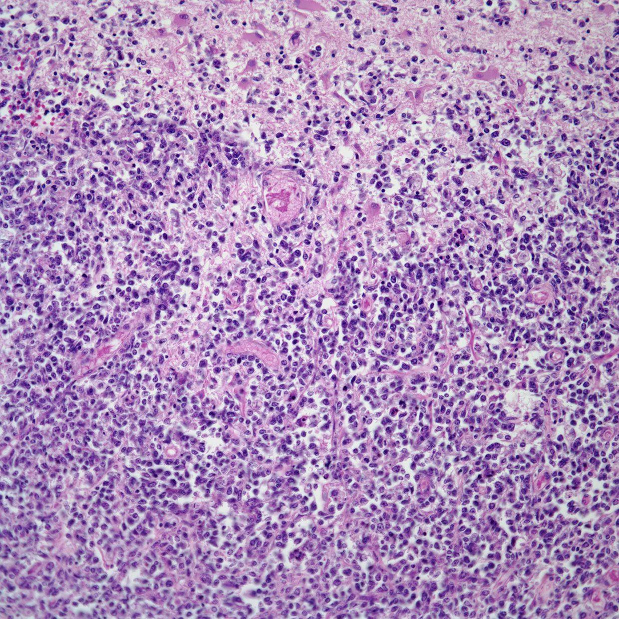 Brain Lesion in 54-Year-Old Patient