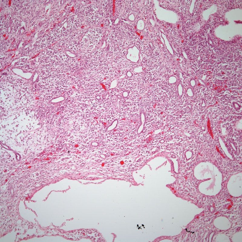 Renal Tumor Discovered in 5-Month-Old Child 