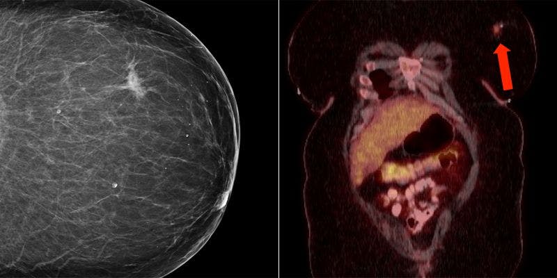 Breast Lesion in Patient With HIV