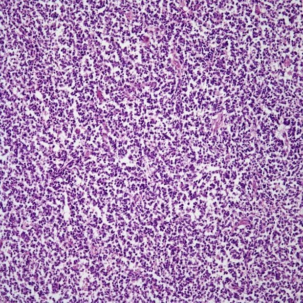 The agent continues to produce ongoing responses in a cohort of patients with undifferentiated pleomorphic sarcoma or myxofibrosarcoma in the phase 2 ENVASARC trial.