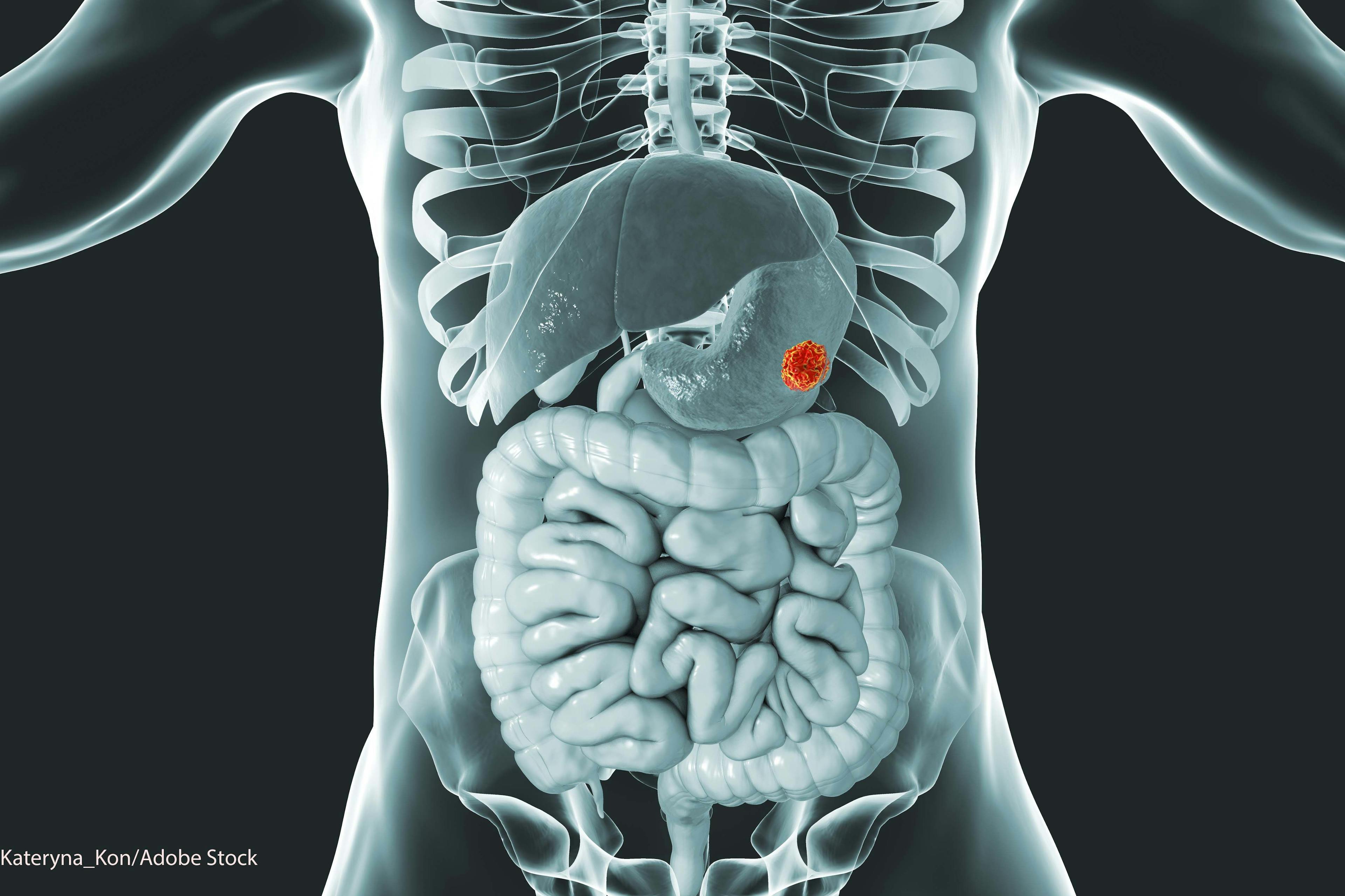 Pembrolizumab/Chemo Improves Responses But Not EFS in Gastric/GEJ Cancer  | Image Credit: © Kateryna_Kon - stock.adobe.com.