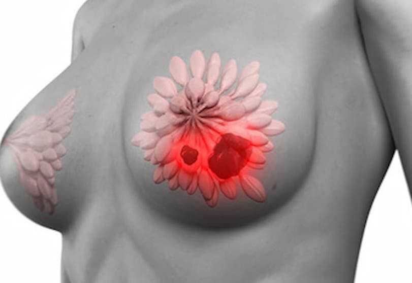 Positive response data were seen when patients with advanced or metastatic triple-negative breast cancer were treated with datopotamab deruxtecan.