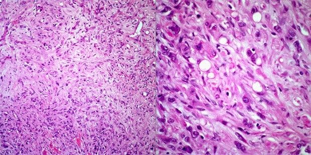 Multiple Liver Nodules Discovered in 43-Year-Old Patient