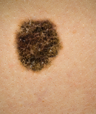 Melanoma Risk Increased in CLL/SLL Patients