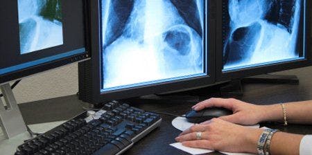 Elderly Get Most Benefit, Harm From Lung Cancer Screening
